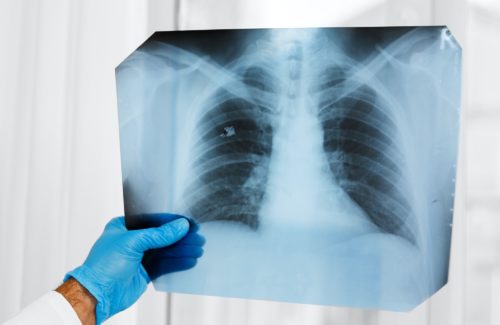 Male doctor examines an x-ray of lungs in hospital